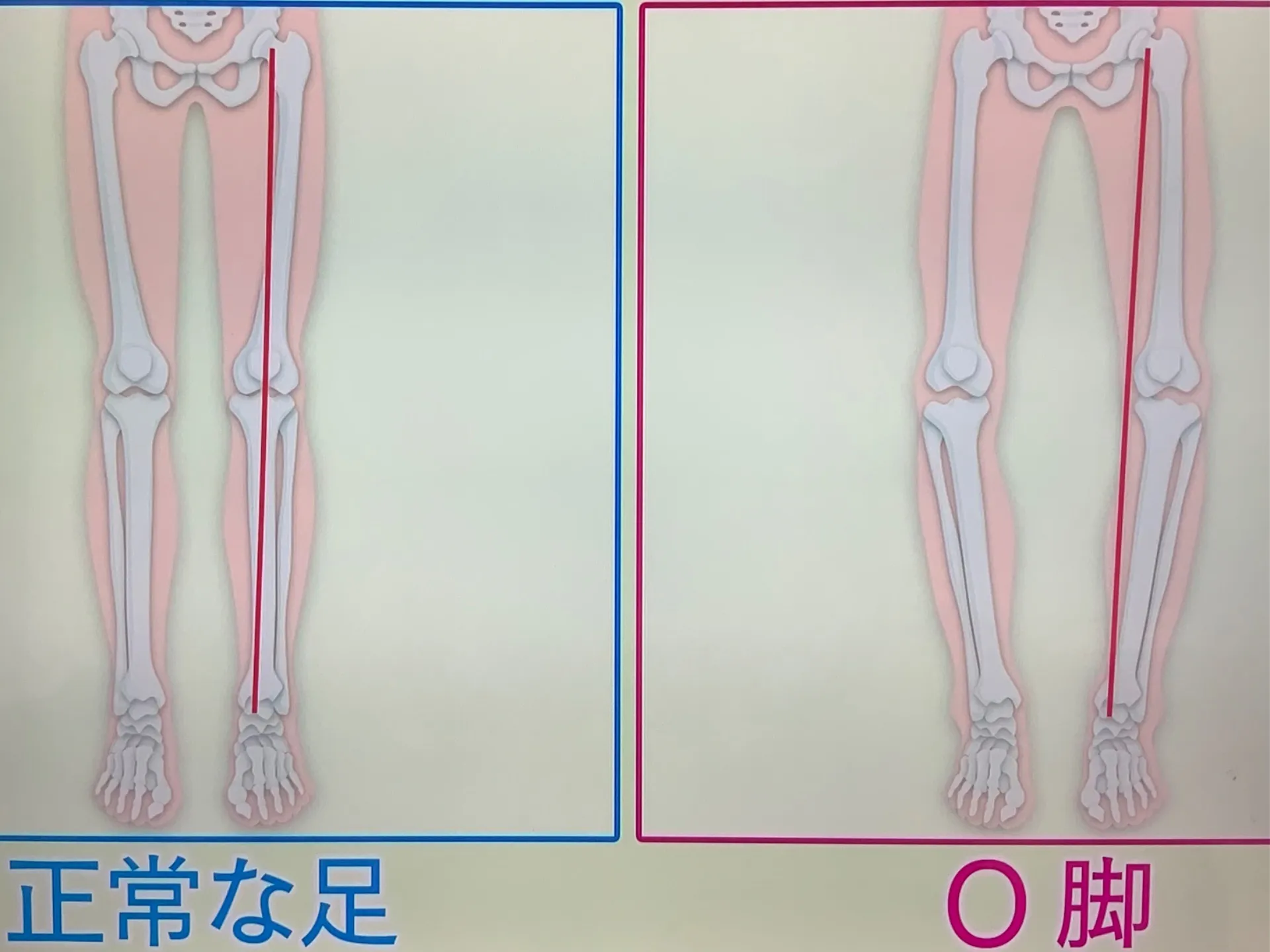 中高齢者の膝の痛み